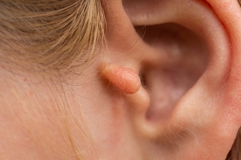 Benign neoplasms of the outer ear in a teenage girl. Congenital ear appendage. A congenital deformity